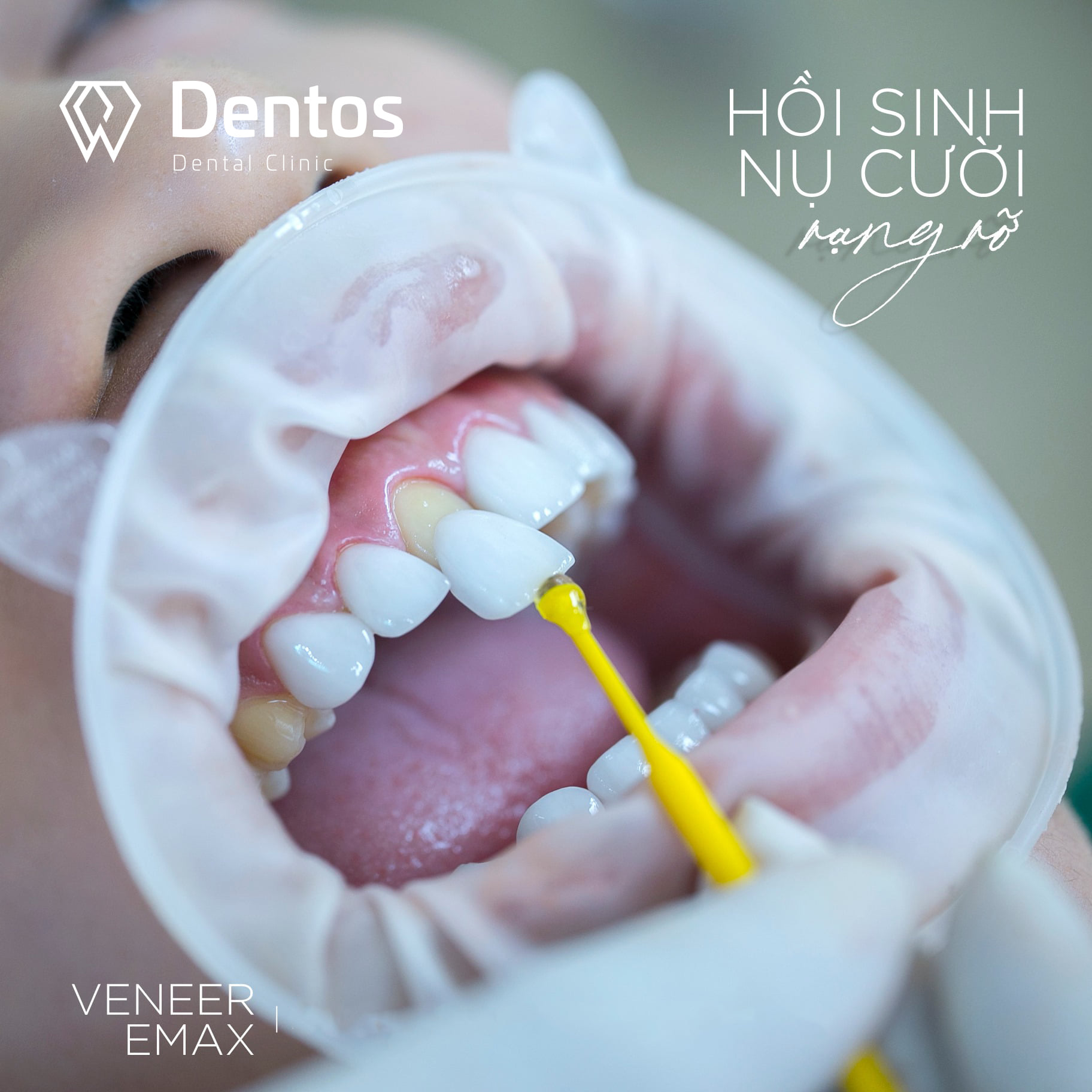 Răng thưa nhiều có thể dán sứ Veneer không cần mài răng